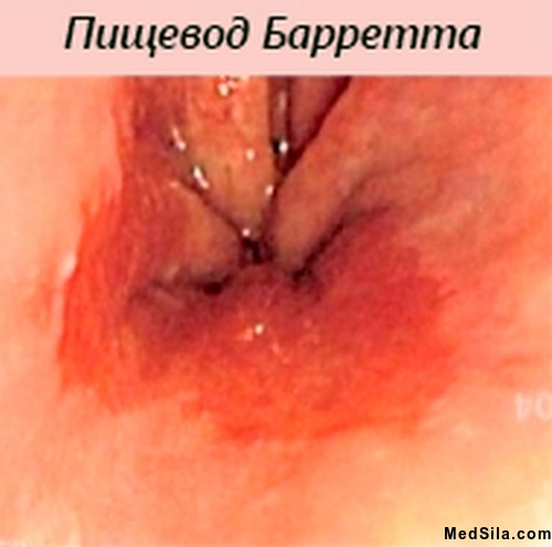 пищевод Баррета