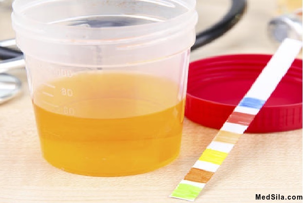 Анализ мочи на МАУ